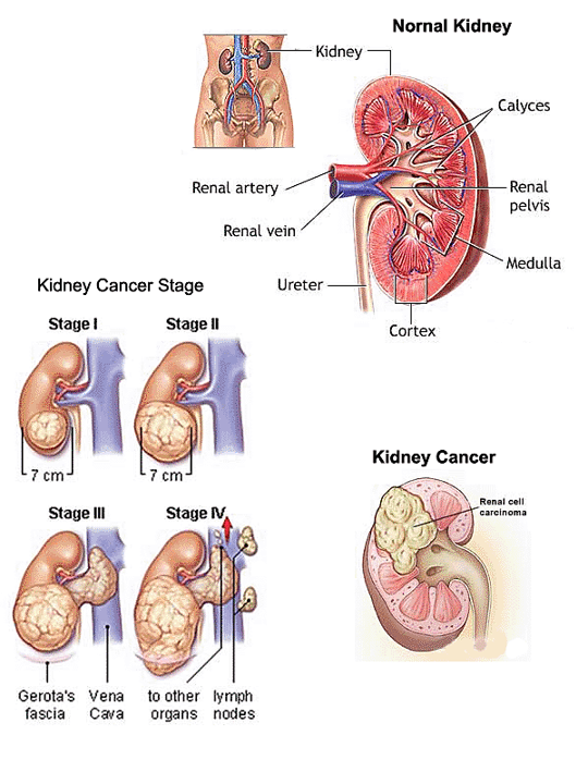 carcinoma renal