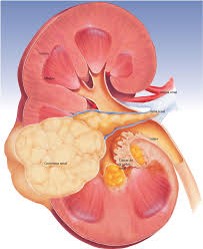 adenocarcinoma renal