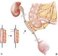 iatrogenias uretero-vesicales